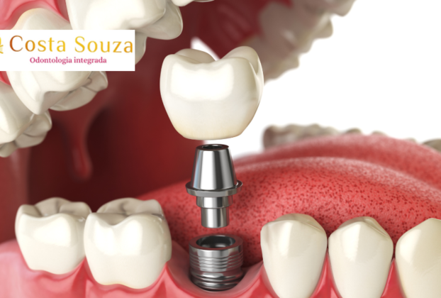 Implante dentário em Icaraí